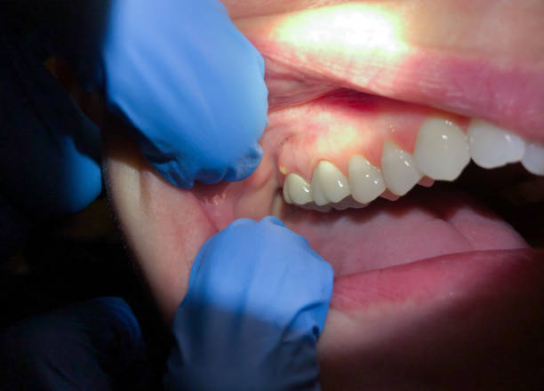 Best Root Canal Emergency Dentist  in Egan, LA