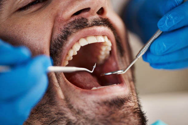 Best Chipped Tooth Repair Near Me  in Egan, LA